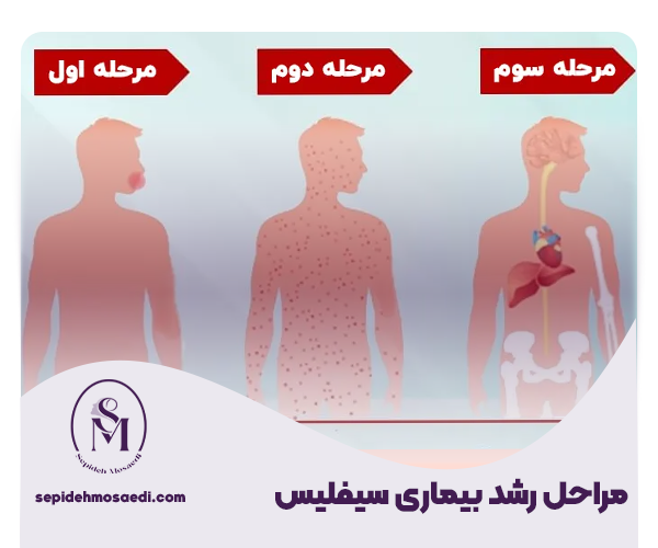 سیفلیس چیست؟ علائم vdrl چیست- راه های درمان 1 مراحل رشد بیماری سیفلیس 1