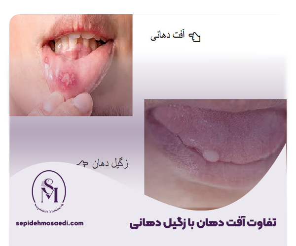 تفاوت آفت دهان با زگیل دهانی 1 1 تفاوت های زگیل دهانی و آفت