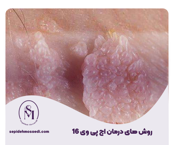 روش های درمان hpv