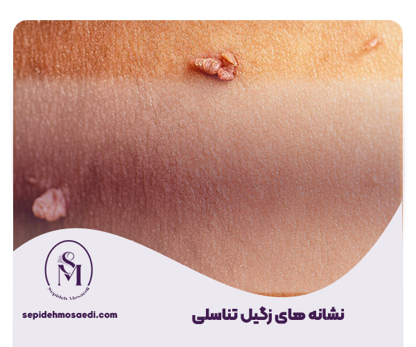 زگیل تناسلی؛ از شناخت ویروس HPV تا درمان کامل 3 1 نشانه های زگیل تناسلی
