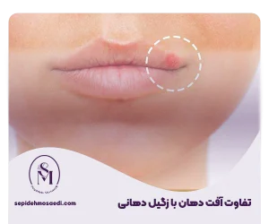 تفاوت زگیل و آفت دهانی