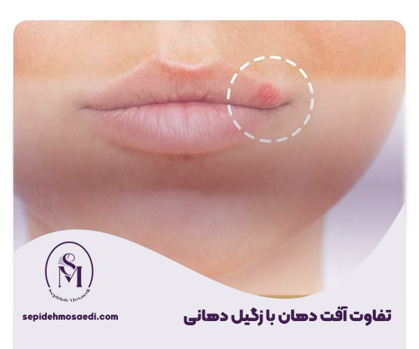 تفاوت زگیل و آفت دهانی
