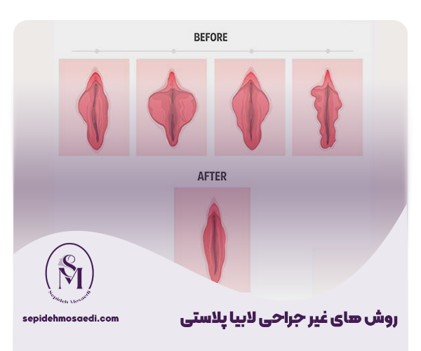 لابیاپلاستی با لیزر 2 2 روش های غیر جراحی لابیا پلاستی