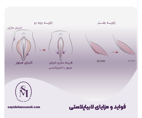 لابیاپلاستی با لیزر 1 مزایا لابیاپلاستی