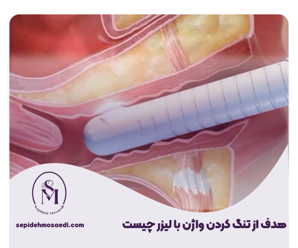 واژینوپلاستی با لیزر