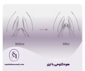 روش انجام هودوکتومی بالیزر