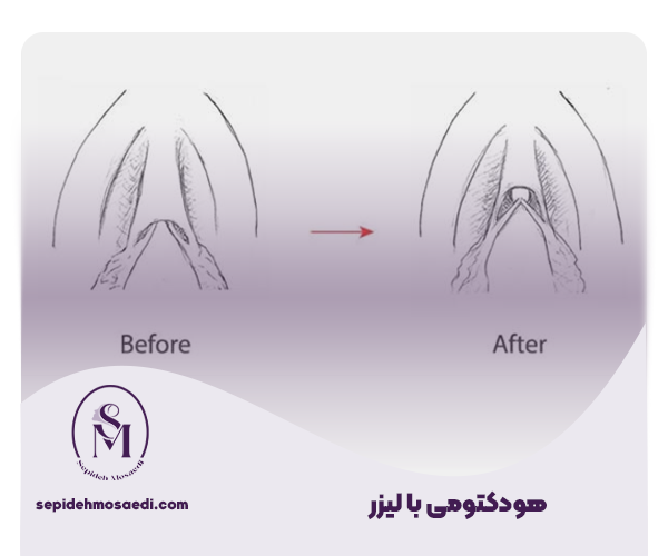روش انجام هودوکتومی بالیزر