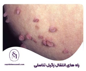 رله های انتقال زگیل تناسلی