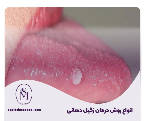 درمان زگیل دهانی؛ از علت تا بهترین روشهای درمان سریع 1 انواع روش درمانی زگیل دهانی