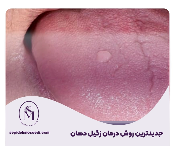 درمان زگیل دهانی؛ از علت تا بهترین روشهای درمان سریع 3 Oral Wart Treatment