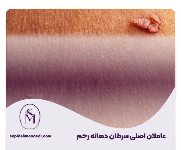 The main causes of cervical cancer