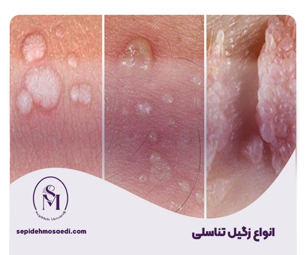 Types of genital warts