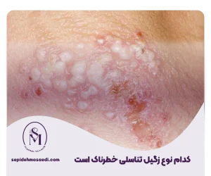 کدام نوع زگیل تناسلی خطرناک است