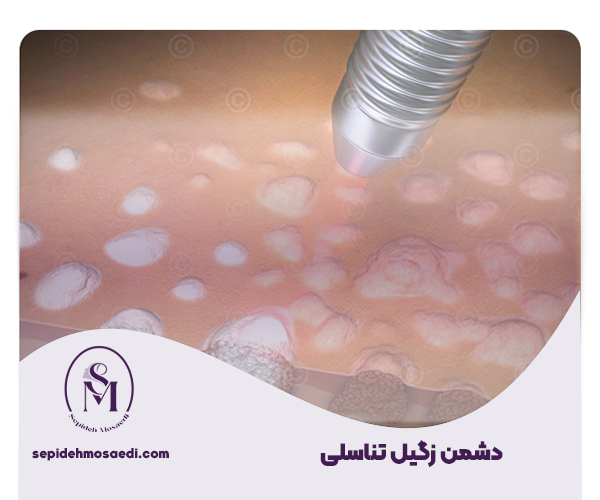 زگیل تناسلی قطعی ترین درمان