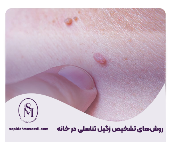 روش تشخیص زگیل تناسلی در خانه