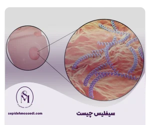 سیفلیس