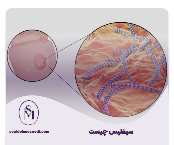 سیفلیس
