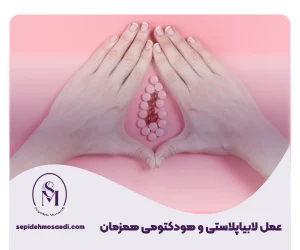 Labiaplasty and hydectomy at the same time