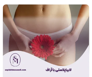 لابیاپلاستی با آر اف