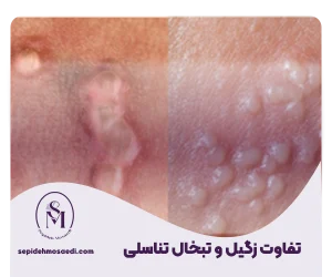 تفاوت زگیل و تبخال تناسلی