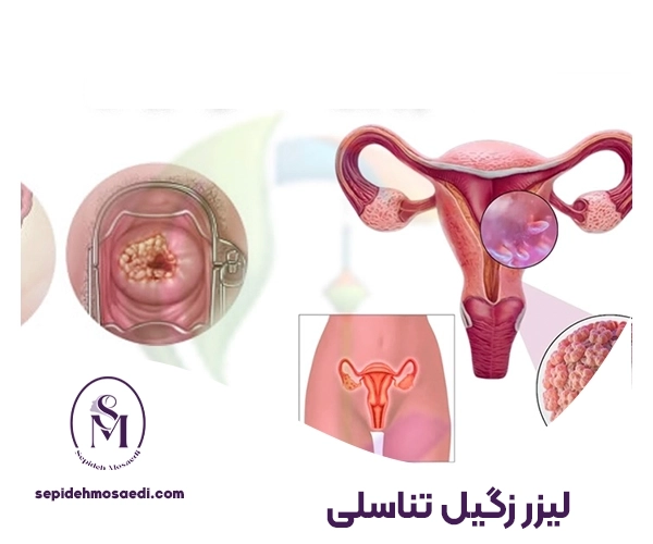 لیزر زگیل تناسلی 4 رابطه بعد از لیزر زگیل تناسلی
