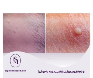 وبلاگ 7 از کجا بفهمیم زگیل تناسلی داریم یا جوش