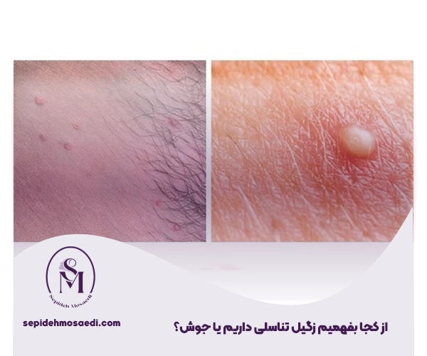 از کجا بفهمیم زگیل تناسلی داریم یا جوش
