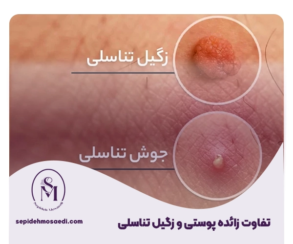 از کجا بفهمیم زگیل تناسلی داریم یا جوش؟ 2 تفاوت جوش با زگیل تناسلی