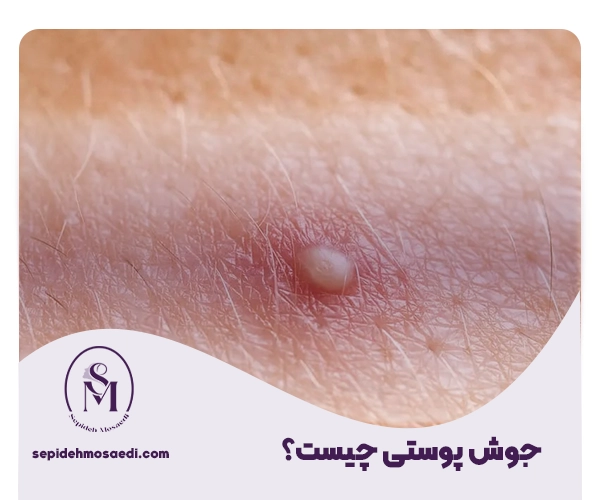 از کجا بفهمیم زگیل تناسلی داریم یا جوش؟ 1 جوش چیست