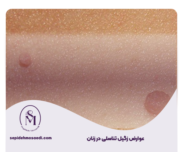 زگیل تناسلی در زنان چه عوارضی دارد؟ 2 عوارض زگیل تناسلی در زنان