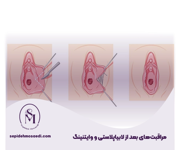 جراحی لابیاپلاستی همزمان با وایتنینگ 2 مراقبتهای بعد از لابیاپلاستی و وایتنینگ