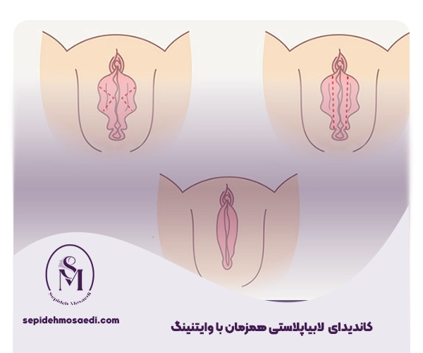 جراحی لابیاپلاستی همزمان با وایتنینگ 3 Labiaplasty surgery at the same time as whitening