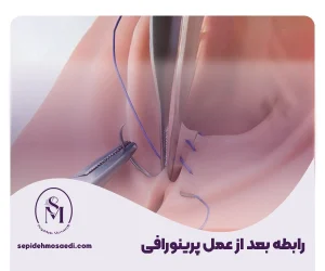 رابطه بعد از پرینورافی