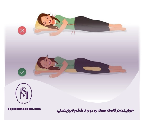 نحوه خوابیدن بعد از عمل لابیاپلاستی؛ راهنمای کامل بهبودی سریع 3 Sleeping after labiaplasty