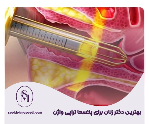 پلاسما تراپی واژن چیست؟ مزایا،ماندگاری و هزینه عمل 3 Vaginal plasmatherapy 2
