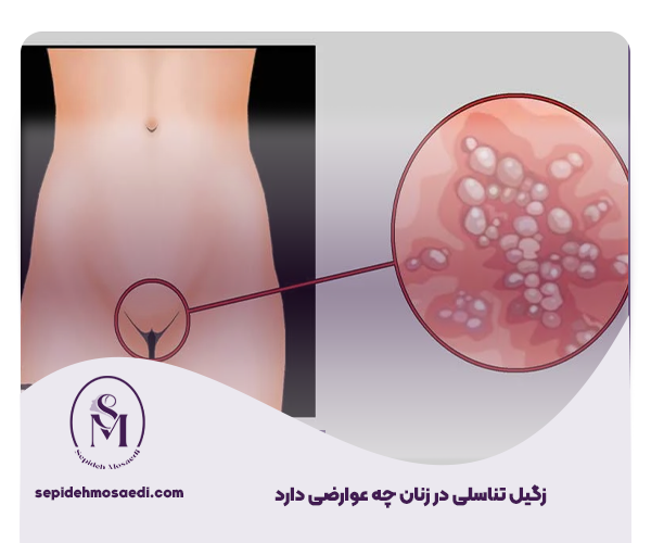 عوارض زگیل تناسلی در زنان