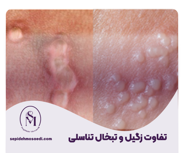 تفاوت زگیل و تبخال تناسلی