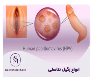 انواع زگیل تناسلی