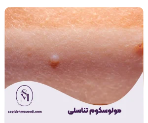مولوسکوم تناسلی