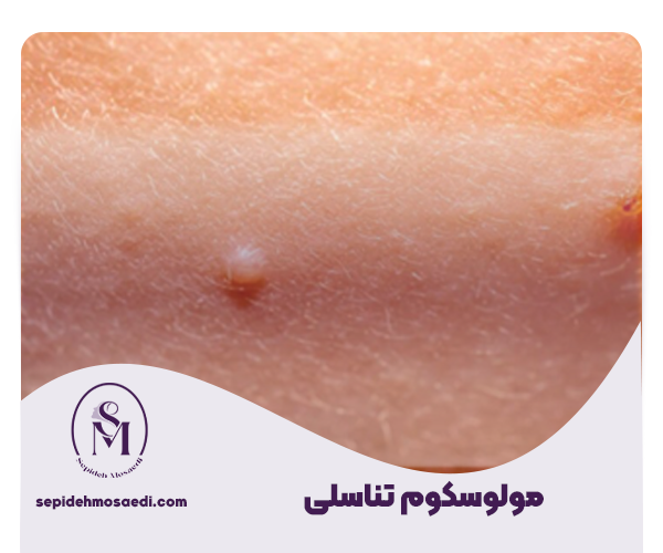 مولوسکوم تناسلی