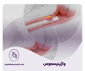 وبلاگ 11 واژینیسموس