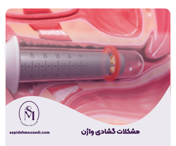 تنگ کردن واژن و انواع آن 3 اقدامات لازم قبل از تنگ کردن واژن