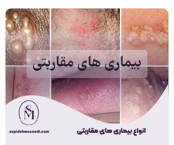 روش های جلوگیری از بیماری های مقاربتی 3 انواع بیماری های مقاربتی