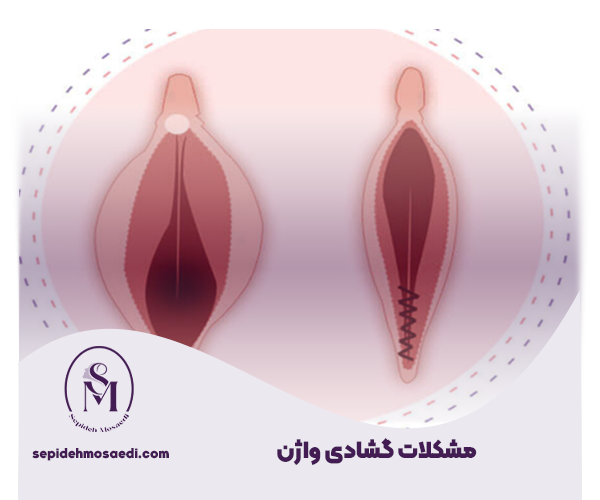تنگ کردن واژن و انواع آن 2 مشکلات گشادی واژن