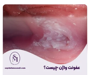 وبلاگ 12 عفونت واژن