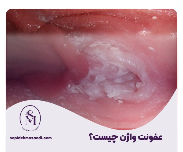 عفونت واژن