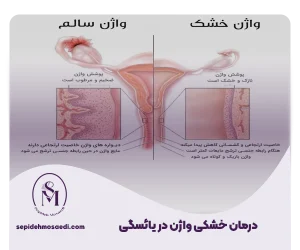 درمان خشکی واژن در یائسگی