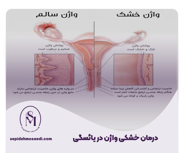 درمان خشکی واژن در یائسگی