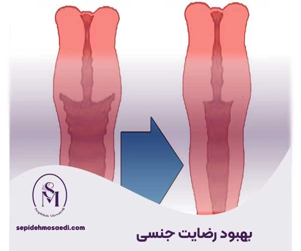 تنگ کردن واژن بعد از بارداری، بررسی علمی و پزشکی بهترین روش ها 2 بهبود رضایت جنسی