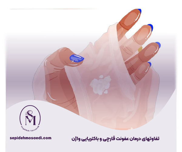 تفاوت عفونت قارچی و باکتریایی واژن، بررسی علائم، ترشحات و درمان 2 تفاوتهای درمان عفونت قارچی و باکتریایی واژن